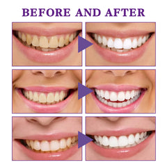 Before and after teeth whitening results showing brighter, whiter smiles