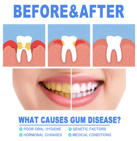 Before and after gum disease treatment showing healthy vs. inflamed gums and teeth whitening results